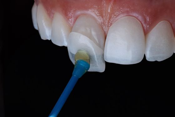 Composición permanente Emax Zirconia carillas laminadas Dental aspecto natural