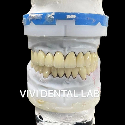Coronas digitales de laboratorio dental CAD CAM de zirconía translúcida en capas