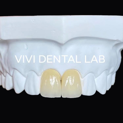 Dental de mandíbula completa Circonia Puente Implante de corona Translucidez Estética