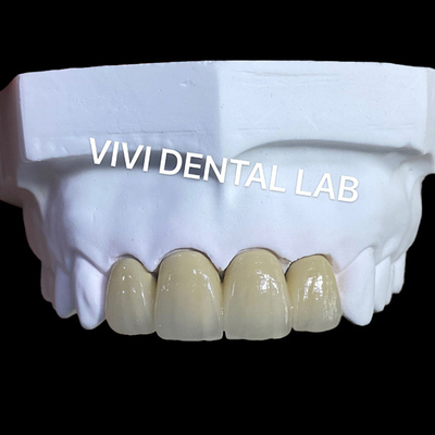 PFM Coronas dentales de laboratorio Técnica SLM con polvo de aleación Scheftner 30