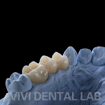 Coronas de laboratorio dentales de contorno completo de alta translucidez Coronas sólidas de zirconia