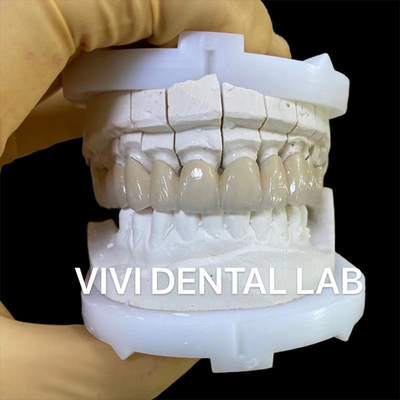 Coronas de laboratorio dentales de precisión Estética de porcelana de zirconia Corona dental