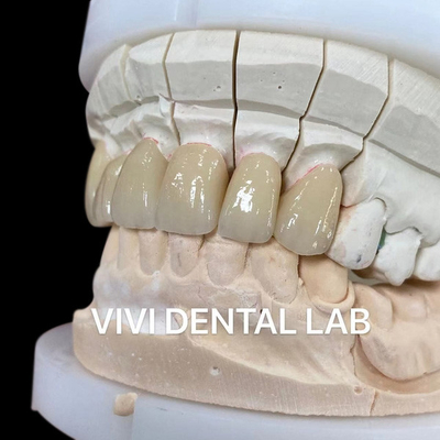 Coronas de laboratorio dentales telescópicas de una sola capa de zirconia Noritake porcelana