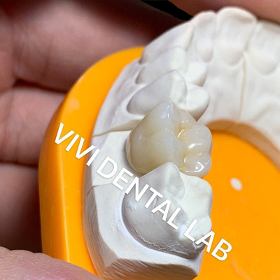El laboratorio dental sólido corona la favorable alta translucidez 3D que la circona llena corona el laboratorio dental de China