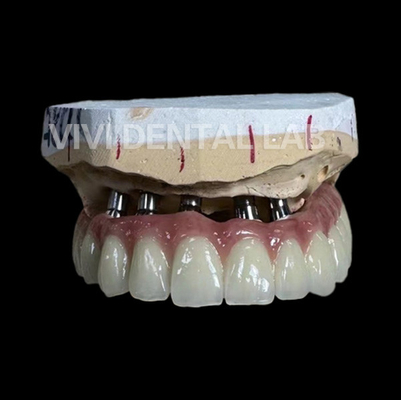 Laboratorio dental de China del puente total del implante PFM