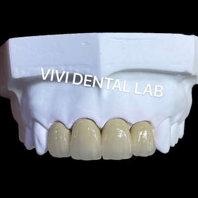 Corona y puente PFM de cerámica de metal de laboratorio dental de China