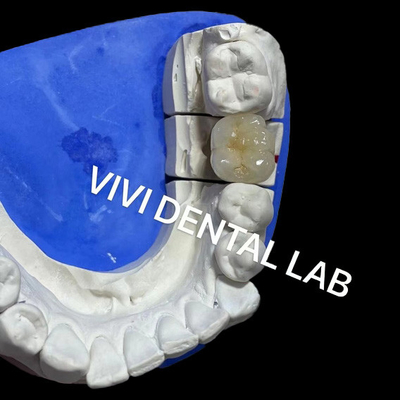 Ivoclar Scheftner Coronas de porcelana metálicas Coronas de cerámica metálicas Ni estar libre