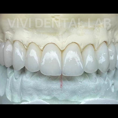 Laboratorio Dental Coroas y puentes de zirconia trabaja profesional estable