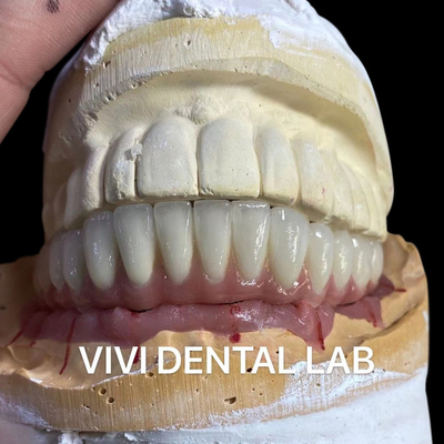 Implante dental Puente cerámico de metal sobre abutments de titanio