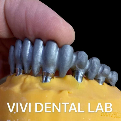 Puente de PFM impreso sobre abutments de múltiples unidades de laboratorio dental de China