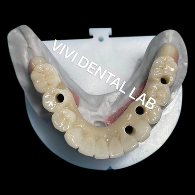 Puente con tornillo de zirconia de múltiples capas, biocompatible con la estructura metálica