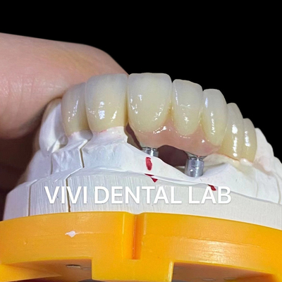 Puente de implantes dentales de porcelana de zirconia alta estética profesional