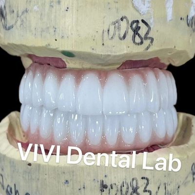 Ni ser libre Zirconia puente de implantes dentales en la barra alta estética
