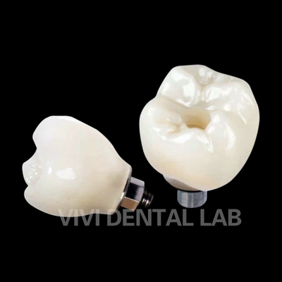 Coroa de implante dental con tornillo retenido PFZ de porcelana con capas de zirconia