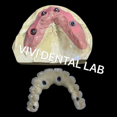 Todo atornillado en cuatro puente de zirconia Ivoclar Dental alta precisión