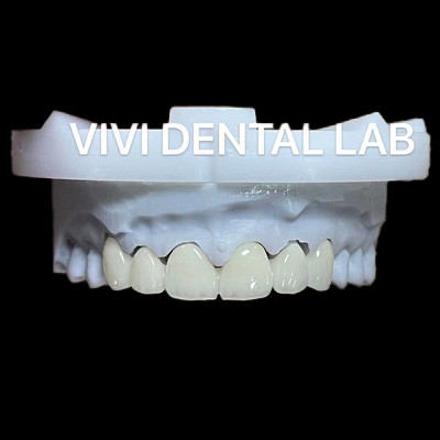 Puente dental anterior de zirconia certificado ISO Tiempo de respuesta rápido