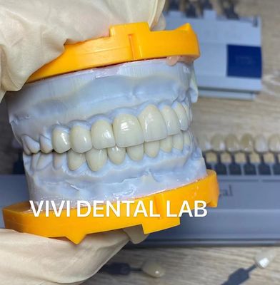 La alta lamina estética de Emax de los dientes chapea el laboratorio dental de China de la translucidez Incisal
