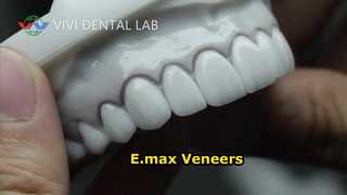 Laminados para Carillas Dentales