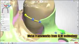 Estructura parcial metálica de tecnología SLM.